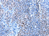 The image on the left is immunohistochemistry of paraffin-embedded Human ovarian cancer tissue using CSB-PA995991 (HMGB1 Antibody) at dilution 1/13, on the right is treated with synthetic peptide. (Original magnification: ×200)