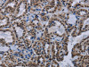 The image on the left is immunohistochemistry of paraffin-embedded Human thyroid cancer tissue using CSB-PA225274 (HMGB1 Antibody) at dilution 1/30, on the right is treated with synthetic peptide. (Original magnification: ×200)