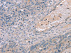 The image on the left is immunohistochemistry of paraffin-embedded Human breast cancer tissue using CSB-PA912041 (TERT Antibody) at dilution 1/35, on the right is treated with synthetic peptide. (Original magnification: ×200)