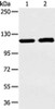 Gel: 6%SDS-PAGE, Lysate: 40 μg, Lane 1-2: Human mucinous type of soft tissue sarcoma and human fetal liver tissue, Primary antibody: CSB-PA199893 (TERT Antibody) at dilution 1/250 dilution, Secondary antibody: Goat anti rabbit IgG at 1/8000 dilution, Exposure time: 1 minute