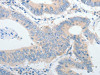 The image on the left is immunohistochemistry of paraffin-embedded Human colon cancer tissue using CSB-PA197609 (IGFBP1 Antibody) at dilution 1/30, on the right is treated with synthetic peptide. (Original magnification: ×200)