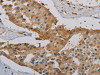 The image on the left is immunohistochemistry of paraffin-embedded Human prostate cancer tissue using CSB-PA032730 (IGFBP1 Antibody) at dilution 1/20, on the right is treated with synthetic peptide. (Original magnification: ×200)