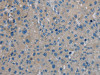 The image on the left is immunohistochemistry of paraffin-embedded Human liver cancer tissue using CSB-PA032730 (IGFBP1 Antibody) at dilution 1/20, on the right is treated with synthetic peptide. (Original magnification: ×200)