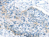 The image on the left is immunohistochemistry of paraffin-embedded Human esophagus cancer tissue using CSB-PA153577 (IGFBP3 Antibody) at dilution 1/45, on the right is treated with synthetic peptide. (Original magnification: ×200)