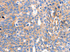 The image on the left is immunohistochemistry of paraffin-embedded Human ovarian cancer tissue using CSB-PA082992 (IGFBP7 Antibody) at dilution 1/50, on the right is treated with synthetic peptide. (Original magnification: ×200)