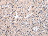 The image on the left is immunohistochemistry of paraffin-embedded Human liver cancer tissue using CSB-PA070545 (IGF1 Antibody) at dilution 1/30, on the right is treated with synthetic peptide. (Original magnification: ×200)