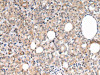 The image on the left is immunohistochemistry of paraffin-embedded Human thyroid cancer tissue using CSB-PA070545 (IGF1 Antibody) at dilution 1/30, on the right is treated with synthetic peptide. (Original magnification: ×200)