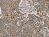 The image on the left is immunohistochemistry of paraffin-embedded Human liver cancer tissue using CSB-PA971812 (IL15RA Antibody) at dilution 1/45, on the right is treated with synthetic peptide. (Original magnification: ×200)