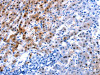 The image on the left is immunohistochemistry of paraffin-embedded Human liver cancer tissue using CSB-PA013952 (IL2RA Antibody) at dilution 1/30, on the right is treated with synthetic peptide. (Original magnification: ×200)