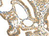 The image on the left is immunohistochemistry of paraffin-embedded Human thyroid cancer tissue using CSB-PA911335 (IL3RA Antibody) at dilution 1/35, on the right is treated with synthetic peptide. (Original magnification: ×200)