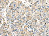 The image on the left is immunohistochemistry of paraffin-embedded Human liver cancer tissue using CSB-PA442043 (INHBB Antibody) at dilution 1/45, on the right is treated with synthetic peptide. (Original magnification: ×200)