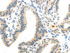 The image on the left is immunohistochemistry of paraffin-embedded Human thyroid cancer tissue using CSB-PA932977 (INHBB Antibody) at dilution 1/40, on the right is treated with synthetic peptide. (Original magnification: ×200)