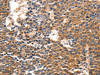 The image on the left is immunohistochemistry of paraffin-embedded Human liver cancer tissue using CSB-PA090613 (IRF1 Antibody) at dilution 1/40, on the right is treated with synthetic peptide. (Original magnification: ×200)