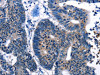 The image on the left is immunohistochemistry of paraffin-embedded Human cervical cancer tissue using CSB-PA235826 (IRF7 Antibody) at dilution 1/10, on the right is treated with synthetic peptide. (Original magnification: ×200)