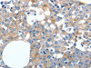 The image on the left is immunohistochemistry of paraffin-embedded Human breast cancer tissue using CSB-PA888287 (LILRB3 Antibody) at dilution 1/20, on the right is treated with synthetic peptide. (Original magnification: ×200)