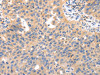The image on the left is immunohistochemistry of paraffin-embedded Human ovarian cancer tissue using CSB-PA036177 (IRS2 Antibody) at dilution 1/50, on the right is treated with synthetic peptide. (Original magnification: ×200)