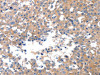 The image on the left is immunohistochemistry of paraffin-embedded Human breast cancer tissue using CSB-PA176985 (MAPK8 Antibody) at dilution 1/50, on the right is treated with synthetic peptide. (Original magnification: ×200)