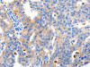 The image on the left is immunohistochemistry of paraffin-embedded Human breast cancer tissue using CSB-PA950615 (MAPK10 Antibody) at dilution 1/10, on the right is treated with synthetic peptide. (Original magnification: ×200)
