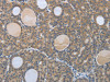 The image on the left is immunohistochemistry of paraffin-embedded Human thyroid cancer tissue using CSB-PA179620 (BRAF Antibody) at dilution 1/60, on the right is treated with synthetic peptide. (Original magnification: ×200)