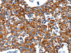 The image on the left is immunohistochemistry of paraffin-embedded Human breast cancer tissue using CSB-PA085005 (KLK2 Antibody) at dilution 1/80, on the right is treated with synthetic peptide. (Original magnification: ×200)