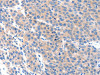 The image on the left is immunohistochemistry of paraffin-embedded Human liver cancer tissue using CSB-PA039286 (KLK2 Antibody) at dilution 1/100, on the right is treated with synthetic peptide. (Original magnification: ×200)