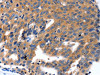 The image on the left is immunohistochemistry of paraffin-embedded Human ovarian cancer tissue using CSB-PA175566 (KLK5 Antibody) at dilution 1/100, on the right is treated with synthetic peptide. (Original magnification: ×200)