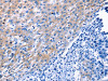 The image on the left is immunohistochemistry of paraffin-embedded Human liver cancer tissue using CSB-PA234333 (LAMA3 Antibody) at dilution 1/30, on the right is treated with synthetic peptide. (Original magnification: ×200)