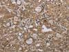 The image on the left is immunohistochemistry of paraffin-embedded Human thyroid cancer tissue using CSB-PA034680 (STMN2/STMN3/STMN4 Antibody) at dilution 1/45, on the right is treated with synthetic peptide. (Original magnification: ×200)