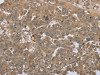 The image on the left is immunohistochemistry of paraffin-embedded Human ovarian cancer tissue using CSB-PA034680 (STMN2/STMN3/STMN4 Antibody) at dilution 1/45, on the right is treated with synthetic peptide. (Original magnification: ×200)