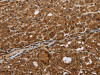 The image on the left is immunohistochemistry of paraffin-embedded Human thyroid cancer tissue using CSB-PA024314 (STMN2/STMN3/STMN4 Antibody) at dilution 1/45, on the right is treated with synthetic peptide. (Original magnification: ×200)