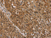 The image on the left is immunohistochemistry of paraffin-embedded Human lung cancer tissue using CSB-PA024314 (STMN2/STMN3/STMN4 Antibody) at dilution 1/45, on the right is treated with synthetic peptide. (Original magnification: ×200)