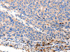 The image on the left is immunohistochemistry of paraffin-embedded Human liver cancer tissue using CSB-PA212407 (OLR1 Antibody) at dilution 1/12, on the right is treated with synthetic peptide. (Original magnification: ×200)