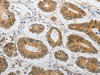 The image on the left is immunohistochemistry of paraffin-embedded Human colon cancer tissue using CSB-PA914116 (LEPR Antibody) at dilution 1/20, on the right is treated with synthetic peptide. (Original magnification: ×200)