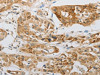 The image on the left is immunohistochemistry of paraffin-embedded Human lung cancer tissue using CSB-PA914116 (LEPR Antibody) at dilution 1/20, on the right is treated with synthetic peptide. (Original magnification: ×200)