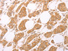 The image on the left is immunohistochemistry of paraffin-embedded Human breast cancer tissue using CSB-PA145488 (LEPR Antibody) at dilution 1/25, on the right is treated with synthetic peptide. (Original magnification: ×200)