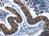 The image on the left is immunohistochemistry of paraffin-embedded Human colon cancer tissue using CSB-PA194222 (LAMA1 Antibody) at dilution 1/25, on the right is treated with synthetic peptide. (Original magnification: ×200)