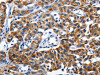 The image on the left is immunohistochemistry of paraffin-embedded Human lung cancer tissue using CSB-PA194222 (LAMA1 Antibody) at dilution 1/25, on the right is treated with synthetic peptide. (Original magnification: ×200)