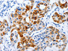The image on the left is immunohistochemistry of paraffin-embedded Human lung cancer tissue using CSB-PA080665 (BPIFB3 Antibody) at dilution 1/120, on the right is treated with synthetic peptide. (Original magnification: ×200)