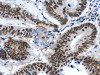 The image on the left is immunohistochemistry of paraffin-embedded Human colon cancer tissue using CSB-PA255528 (LRP5 Antibody) at dilution 1/55, on the right is treated with synthetic peptide. (Original magnification: ×200)
