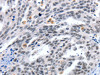 The image on the left is immunohistochemistry of paraffin-embedded Human ovarian cancer tissue using CSB-PA255528 (LRP5 Antibody) at dilution 1/55, on the right is treated with synthetic peptide. (Original magnification: ×200)