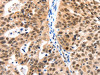 The image on the left is immunohistochemistry of paraffin-embedded Human ovarian cancer tissue using CSB-PA200092 (LRP5 Antibody) at dilution 1/115, on the right is treated with synthetic peptide. (Original magnification: ×200)