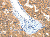 The image on the left is immunohistochemistry of paraffin-embedded Human ovarian cancer tissue using CSB-PA163355 (LRPPRC Antibody) at dilution 1/15, on the right is treated with synthetic peptide. (Original magnification: ×200)