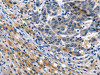 The image on the left is immunohistochemistry of paraffin-embedded Human liver cancer tissue using CSB-PA782639 (ITGAX Antibody) at dilution 1/15, on the right is treated with synthetic peptide. (Original magnification: ×200)