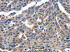 The image on the left is immunohistochemistry of paraffin-embedded Human ovarian cancer tissue using CSB-PA782639 (ITGAX Antibody) at dilution 1/15, on the right is treated with synthetic peptide. (Original magnification: ×200)