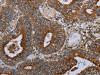 The image on the left is immunohistochemistry of paraffin-embedded Human colon cancer tissue using CSB-PA425800 (MAFF Antibody) at dilution 1/20, on the right is treated with synthetic peptide. (Original magnification: ×200)