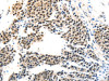 The image on the left is immunohistochemistry of paraffin-embedded Human liver cancer tissue using CSB-PA583147 (MAGEA6 Antibody) at dilution 1/120, on the right is treated with synthetic peptide. (Original magnification: ×200)