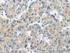 The image on the left is immunohistochemistry of paraffin-embedded Human liver cancer tissue using CSB-PA178736 (MASP2 Antibody) at dilution 1/35, on the right is treated with synthetic peptide. (Original magnification: ×200)