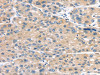 The image on the left is immunohistochemistry of paraffin-embedded Human liver cancer tissue using CSB-PA159806 (MASP2 Antibody) at dilution 1/35, on the right is treated with synthetic peptide. (Original magnification: ×200)