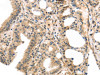 The image on the left is immunohistochemistry of paraffin-embedded Human thyroid cancer tissue using CSB-PA159806 (MASP2 Antibody) at dilution 1/35, on the right is treated with synthetic peptide. (Original magnification: ×200)