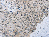 The image on the left is immunohistochemistry of paraffin-embedded Human esophagus cancer tissue using CSB-PA968241 (SLC16A4 Antibody) at dilution 1/80, on the right is treated with synthetic peptide. (Original magnification: ×200)